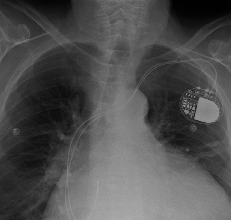 Pacemaker, svensk uppfinning av ke Senning och Rune Elmqvist.